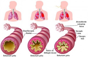 Kronik Astım ve Alerjiye Karşı Ne Yapmalı