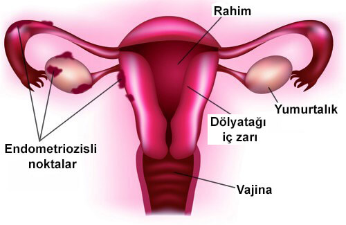 Endometriozis Hastalığının Temel Belirtileri