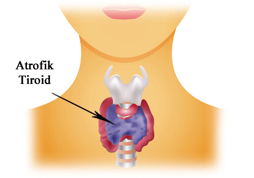 atrofik tiroit