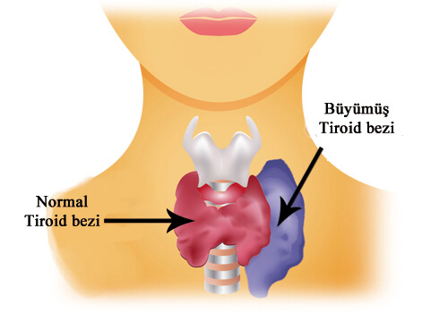 tiroid2