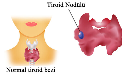 Tiroid3