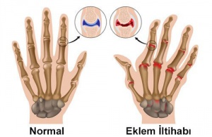 Kireçlenme İçin Tedavi Yöntemleri