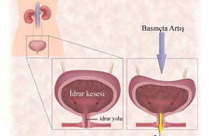 Kadınlarda İdrar Kaçırma Sorununa Karşı Egzersizler