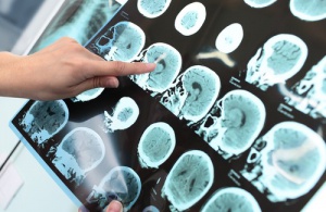 Alzheimer Hastalığı Önlenebilir mi?