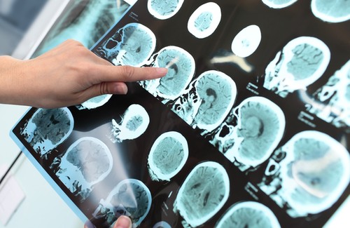Alzheimer Hastalığı Önlenebilir mi?