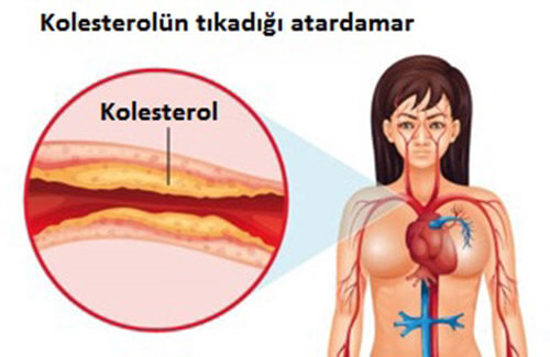 Kolesterol Düzeyi Nasıl Kontrol Altında Tutulabilir?