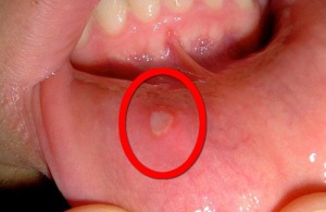 Ağızda Çıkan Yaralar için Ev Yapımı Reçeteler