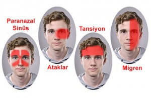 Migren Ağrıları için Yeni ve Etkili Tedaviler