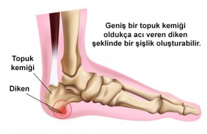 Topuk Dikeni Nasıl Önlenir?