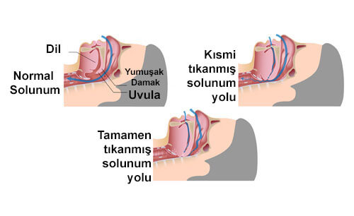 Horlama Neden Olur ve Tedavi Yöntemleri Nelerdir ?