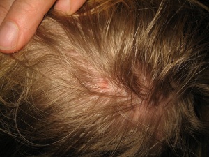 Çocuklar İçin Doğal Bit İlaçları