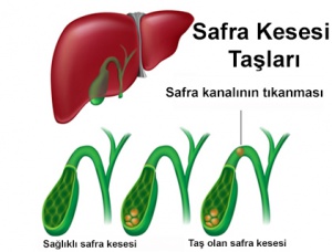 Safra Kesesi Taşı: Belirtileri ve Tedavisi