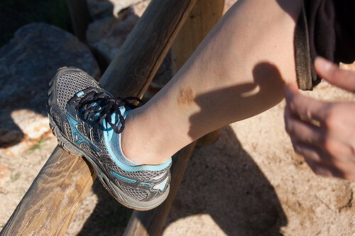 bacakta görülen egzama