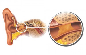 Doğal Yöntemlerle Kulak Kiri Temizliği