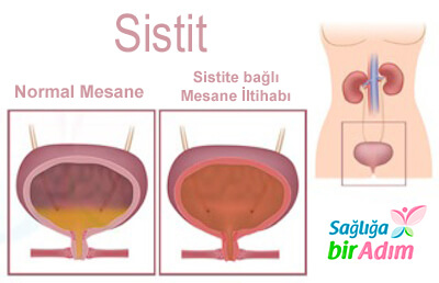 kadınlarda sistit idrar yolu