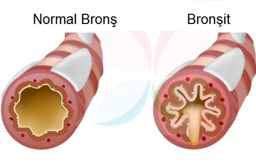 bronşit hastalıkları