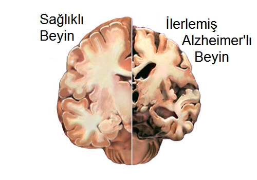 Alzheimer hastalığı ve beyin