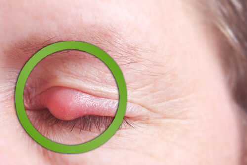 Arpacık Sorununu Nasıl Hızla Ortadan Kaldırabilirsiniz?