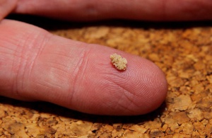 Böbrek Taşı: Belirtileri, Sebepleri, Etkileri ve Tedavisi