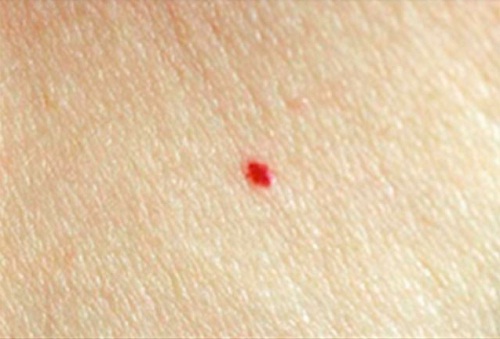 doğumda oluşan leke