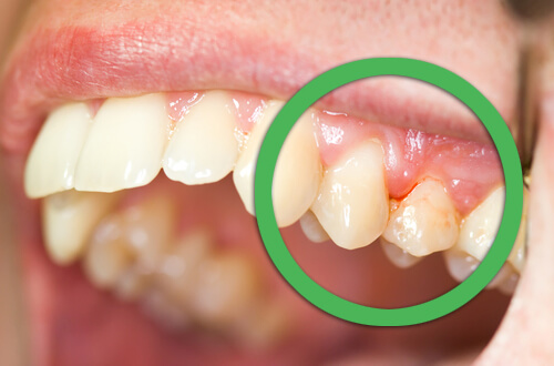 Diş Eti Kanaması ve Sallanan Dişler İçin Doğal Tedaviler