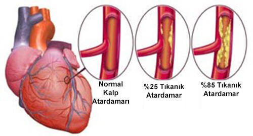 kadınlarda kalp yetmezliği