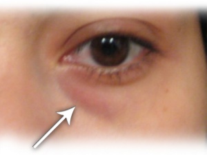 Göz Altı Torbalarından Kurtulmak İçin Ev Yapımı Çözümler