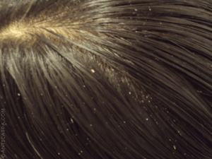 Kepekle Mücadele için Doğal Çözümler