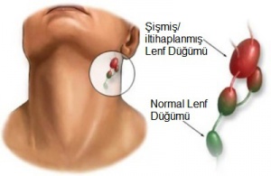 Lenf Düğümü İltihabı Neden Olur?