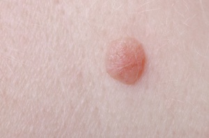 Siğiller Neden Oluşur?