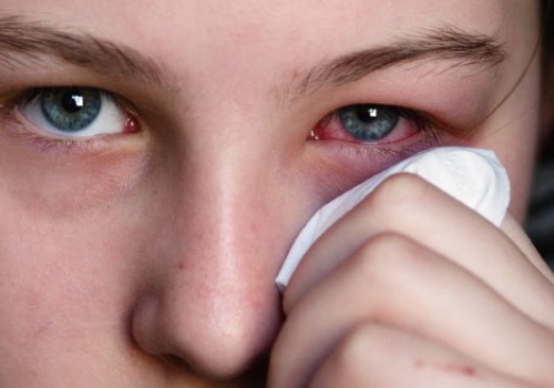 Göz Kanlanması: Nedenleri ve Tedavisi - Sağlığa bir adım