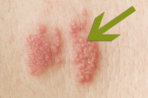 Zona Hastalığı Nedir ve Nasıl Görünür?