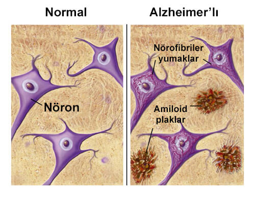 Alzheimer Hastalığından Koruyan Besinler
