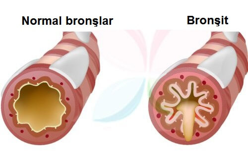 bronşit