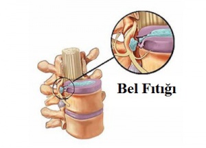 Disk Kayması (Fıtık) ile İlişkilendirilen Belirtiler