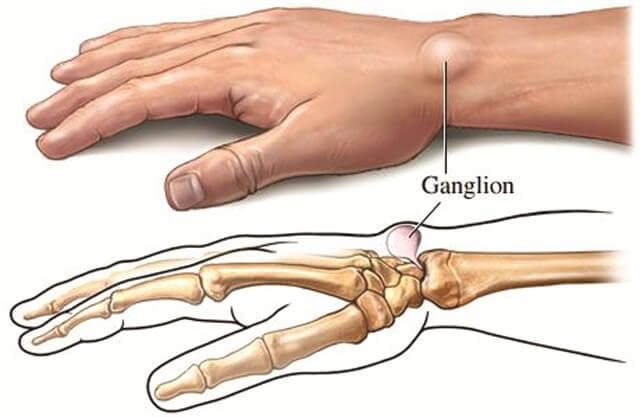 ganglion kisti