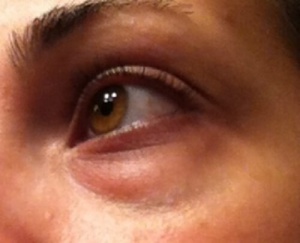 Göz Altı Torbaları mı? Doğal Yollarla Kurtulun!