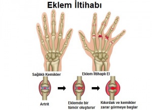 Eklem İltihabı İçin Tetikleyici Unsurlar Nelerdir?