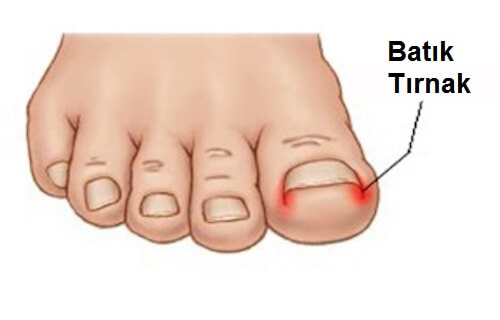 tırnak batması