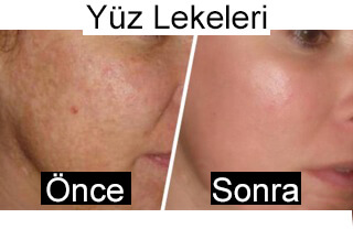 yüz lekeleri