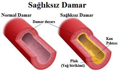 atherosclerosis