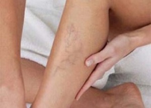 Zayıf Kan Dolaşımı Nasıl Hızlandırılır?