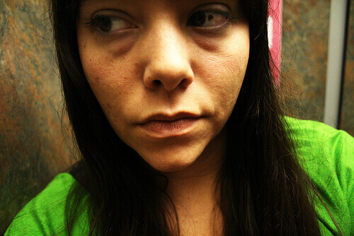 genç yaşta kırışıklık