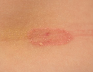 Ayak Mantarını Önlemek İçin Neler Yapabiliriz?