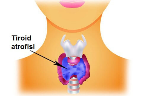 tiroid yetmezliği