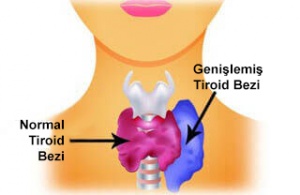 Kadınlarda Hipertiroidizm: Belirtileri ve Önerilen Yiyecekler