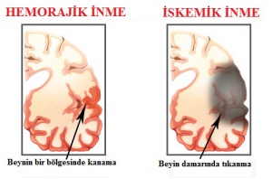 İnme Belirtileri ve Tedavisi Nelerdir?