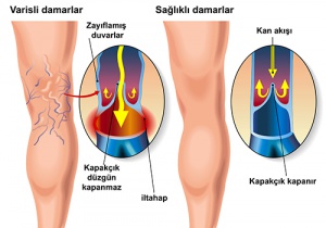 Varisli Damarlar için Egzersizler