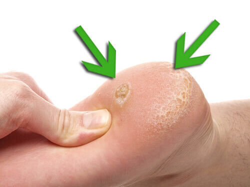 Calluses-Copy