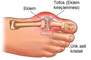 Gut Hastalığının Belirtileri ve Tedavisi